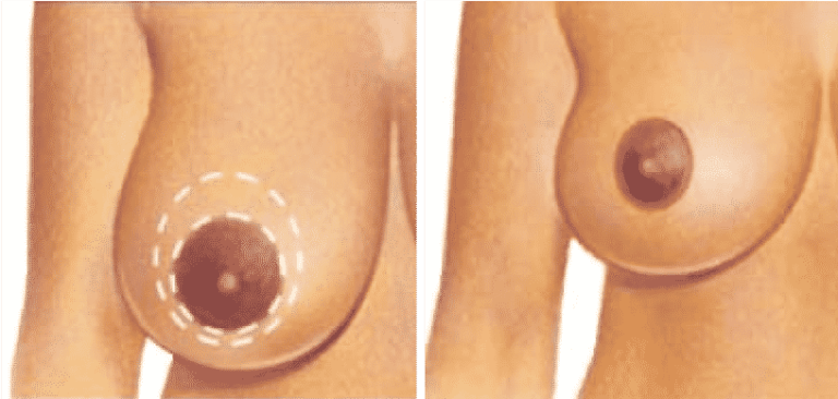 types of breast lift surgery turkey