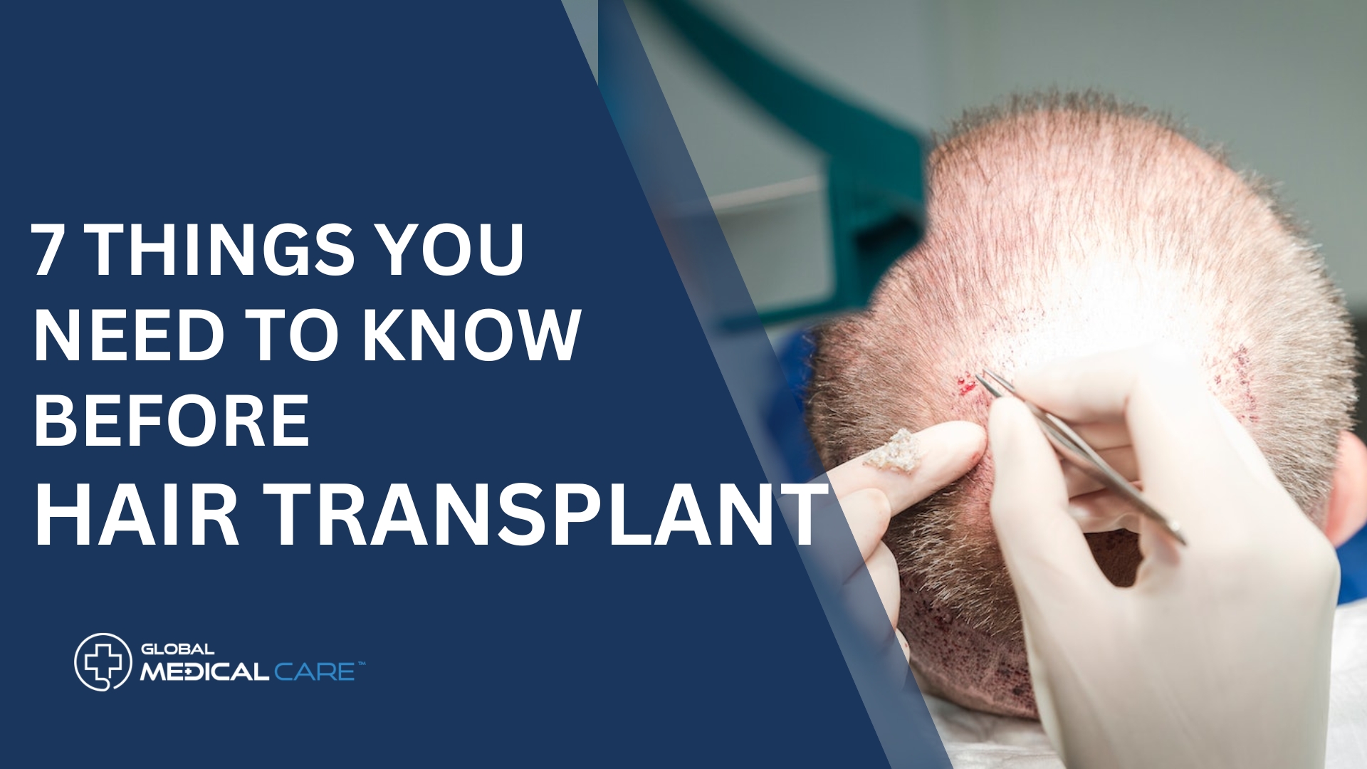 7 Things You Need To Know Before hair transplant