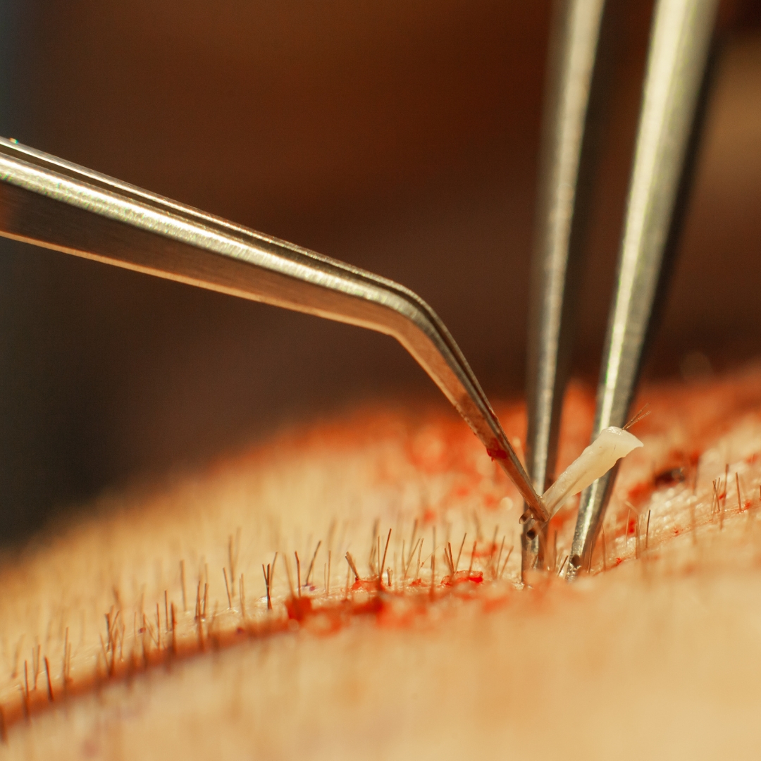 hair transplant packages in turkey