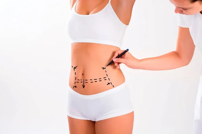 abdominoplasty tummy tuck surgery turkey