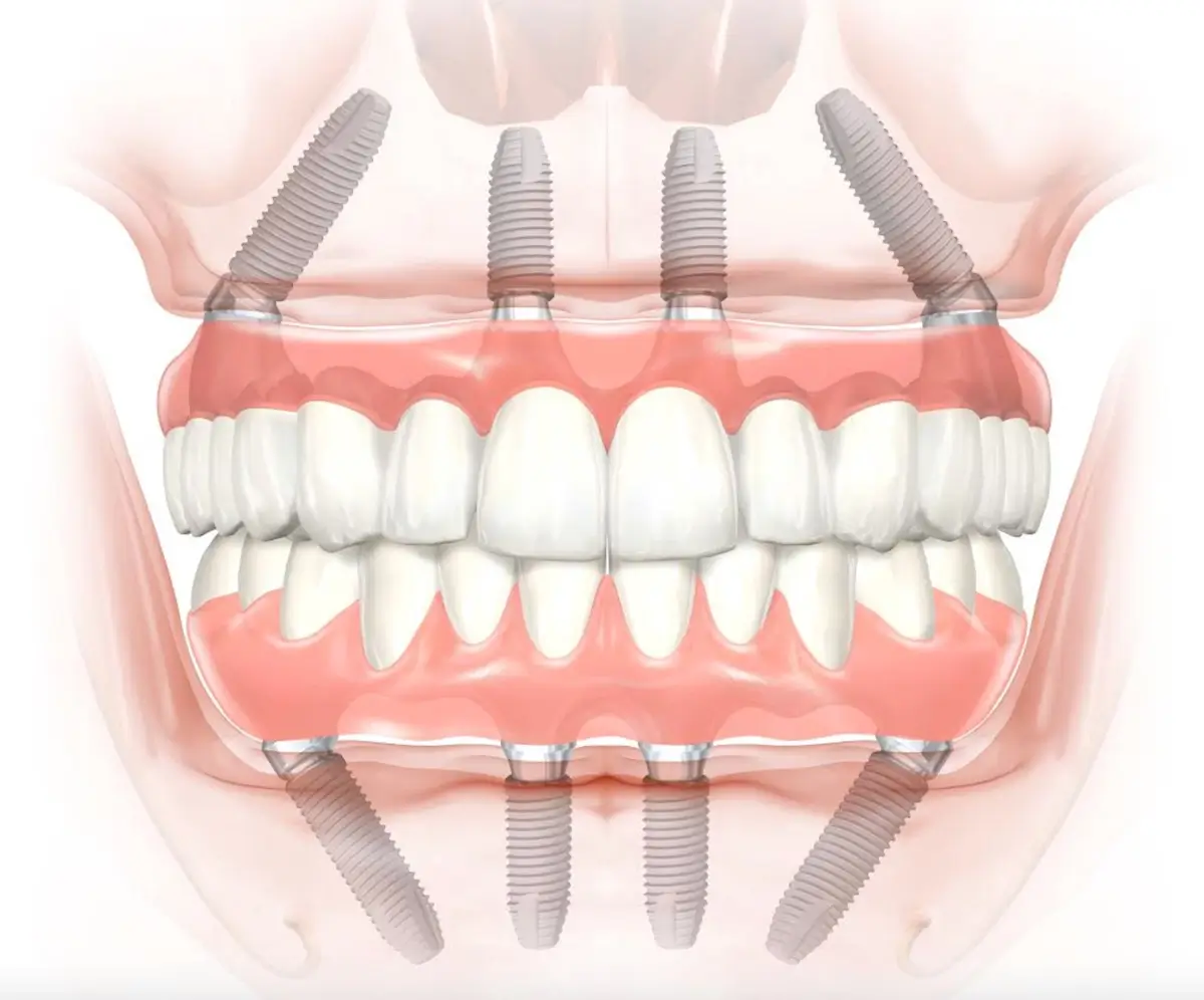 All-on-4-Zahnimplantate können eine lebensverändernde Lösung für Sie sein, wenn Ihnen mehrere Zähne fehlen oder Sie an schwerer Karies leiden.