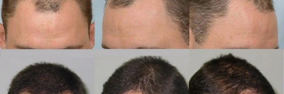 3 Months After Hair Transplant