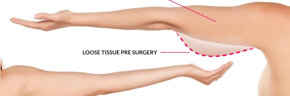 Brachioplasty-updraft-pre-smush-original
