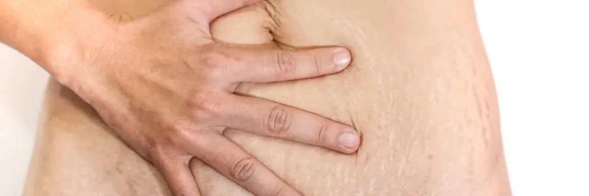 Non-Surgical Belly Fat Reduction in Turkey