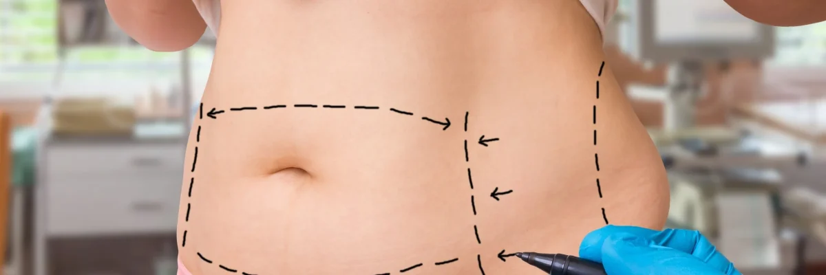 Tummy Tuck Abdominoplasty vs Liposuction