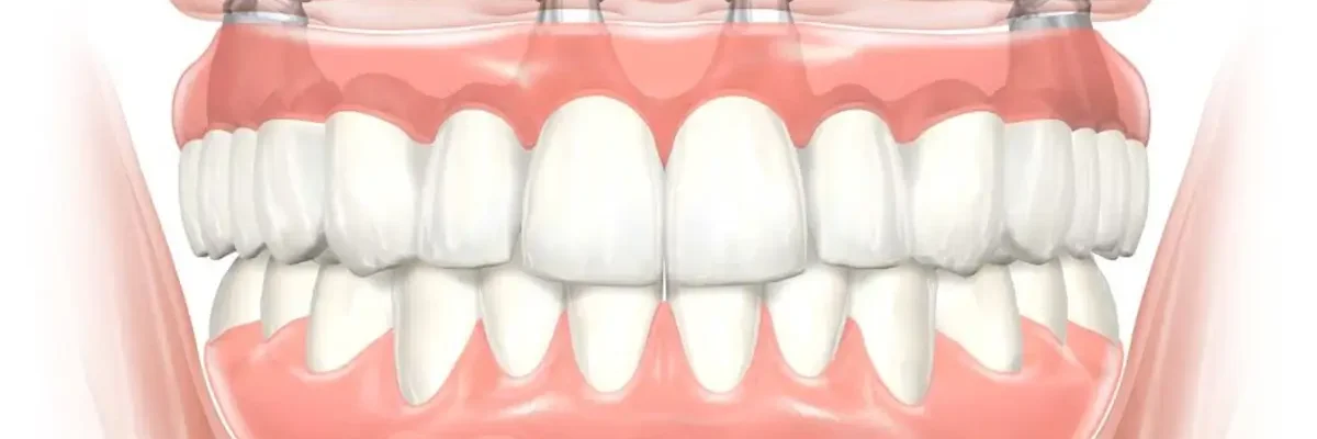 All On 4 dental implants
