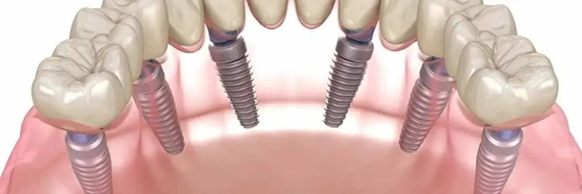 All on 6 dental implants