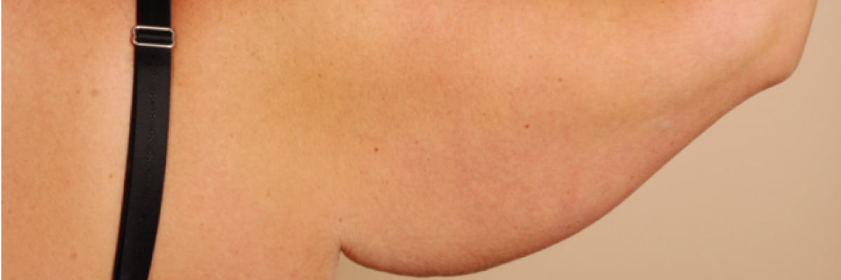 post bariatric arm lift surgery turkey