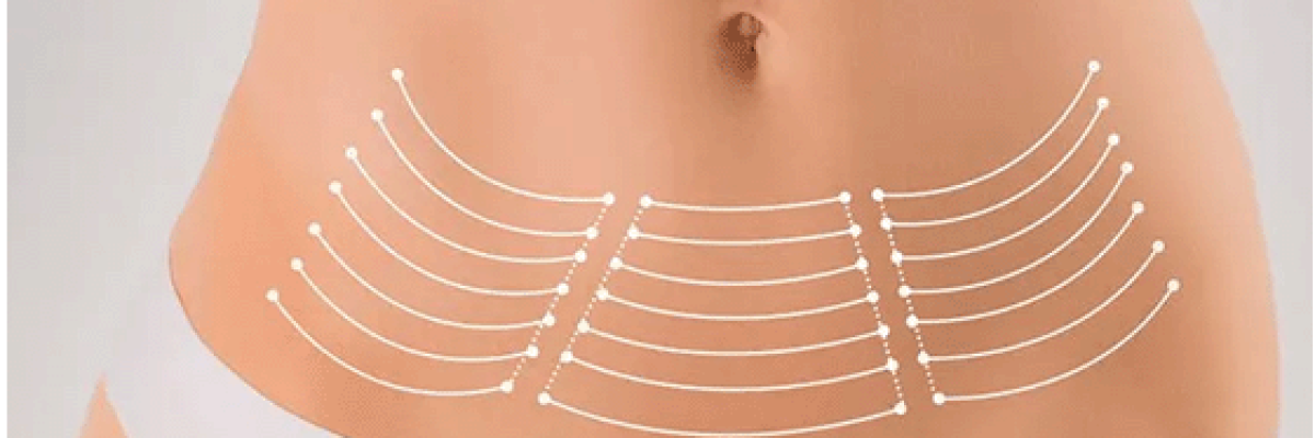 Post-bariatric surgery turkey