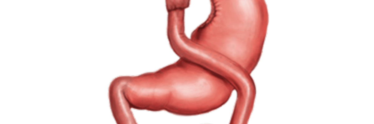 Causes and Prevention of Leakage after Gastric Bypass