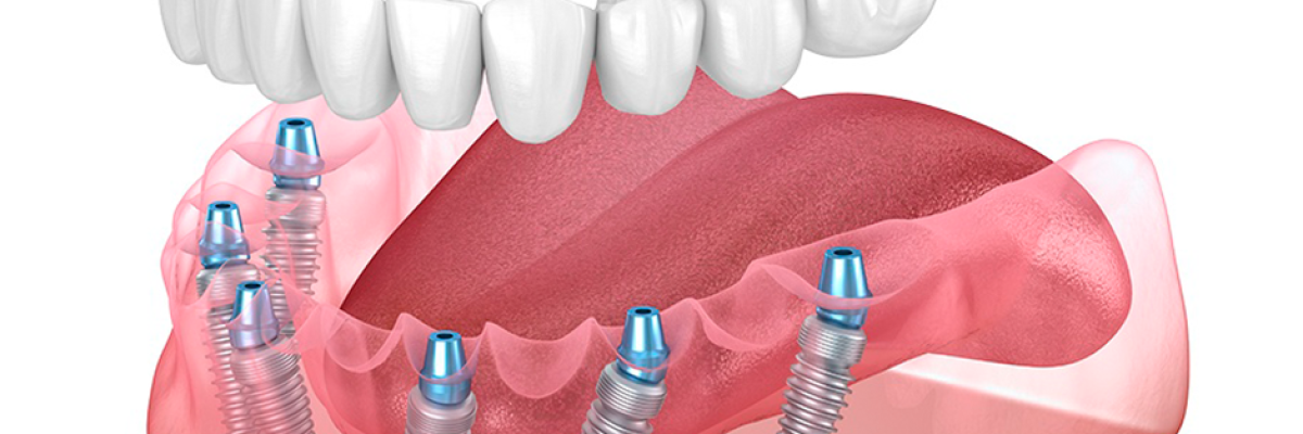 All On 6 Dental Implants