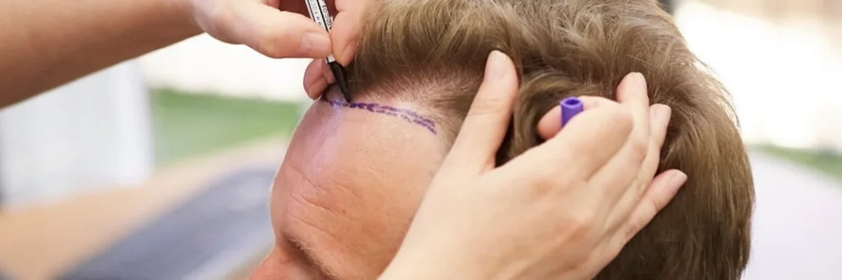Emergence of the Direct Hair Implantation (DHI) technique has revolutionised the world of hair transplantation.
