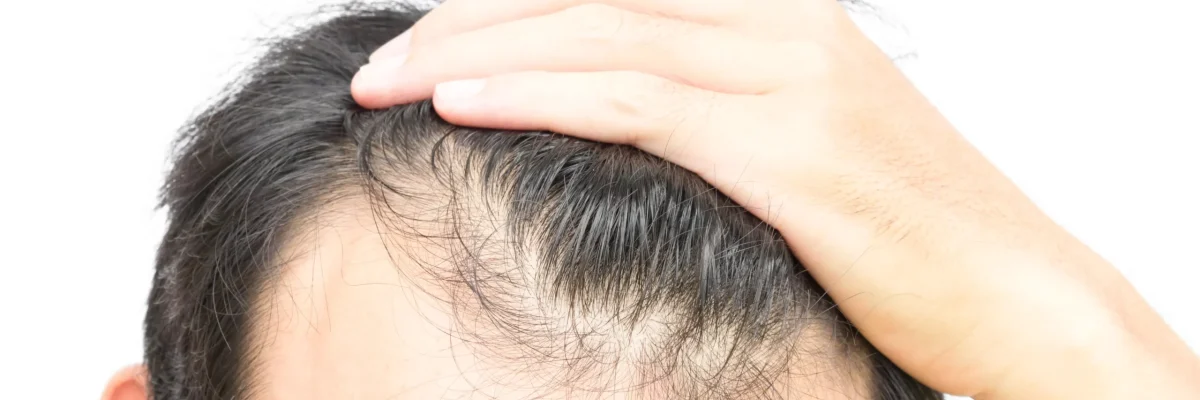 We'll explore male hair loss, the causes and symptoms of male pattern hair loss, and the steps you can take to manage the early stages.