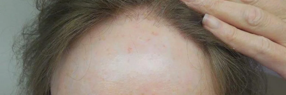 Frontal Fibrosing Alopecia: Causes, Symptoms, and Treatment