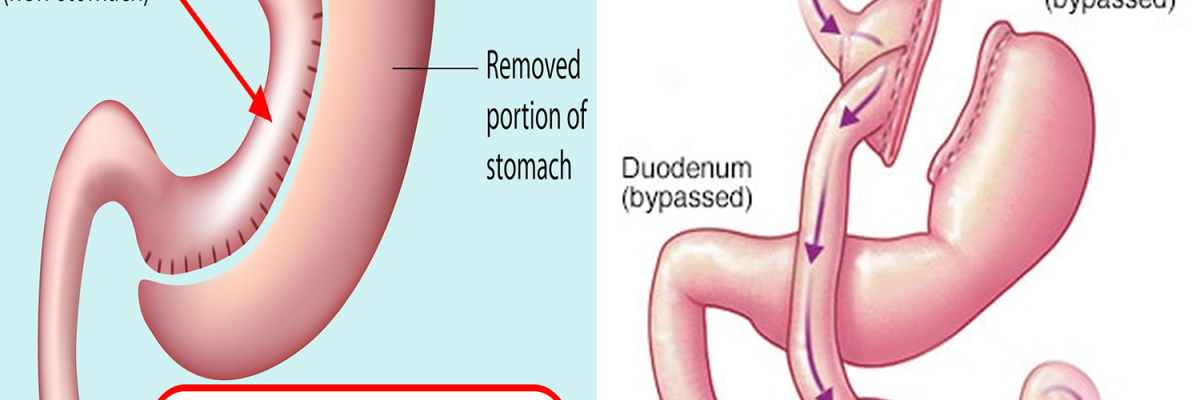 gastric-sleeve-vs-gastric-bypass