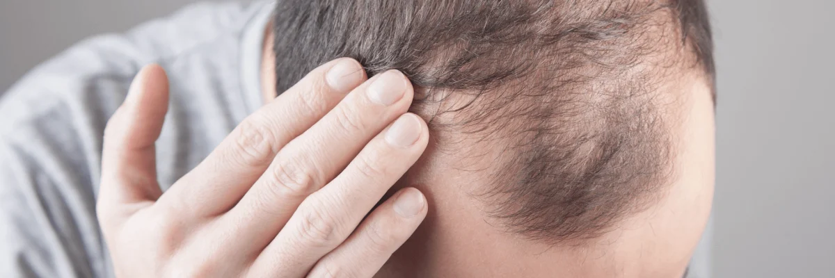 Hair Transplant for Thinning