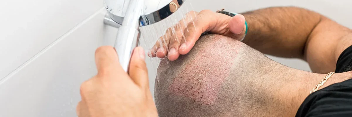 Hair washing after hair transplantation