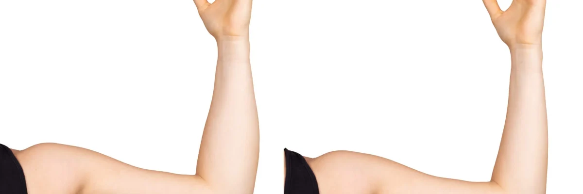 How painful is an arm lift