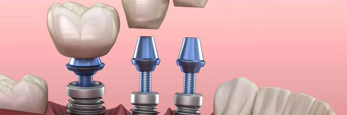 Permanent implants