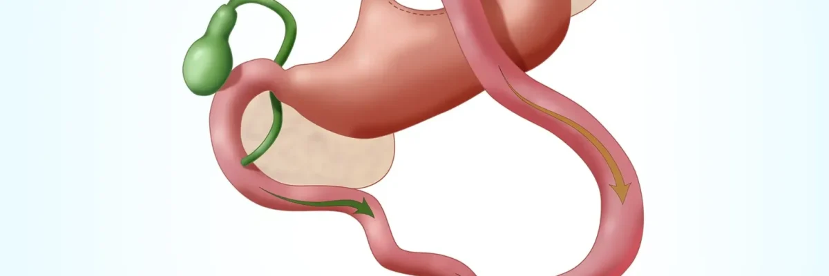 Reviews of Gastric Bypass in Turkey
