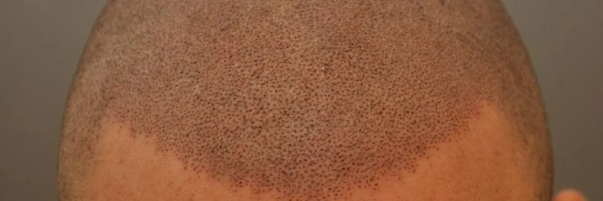Scalp Micropigmentation After Hair Transplant
