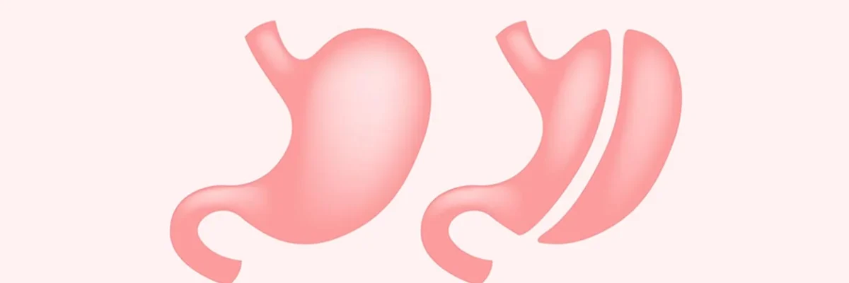 Sleeve stomach