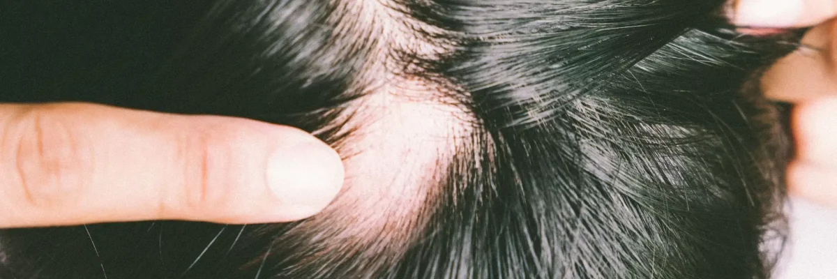Spotted Hair Loss