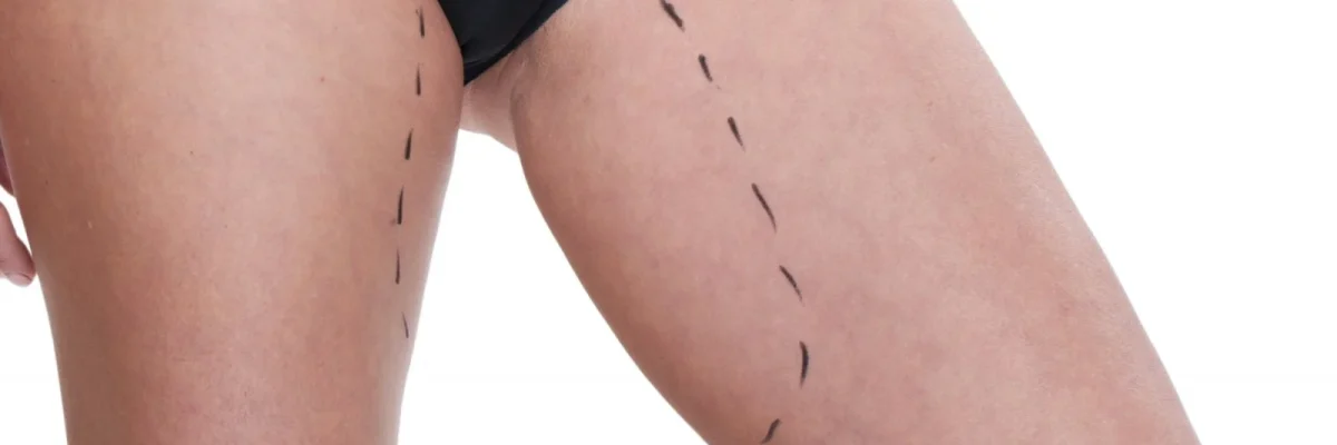 Cost of thigh lift surgery