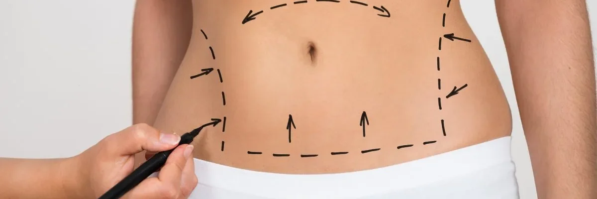 Mini Tummy Tuck