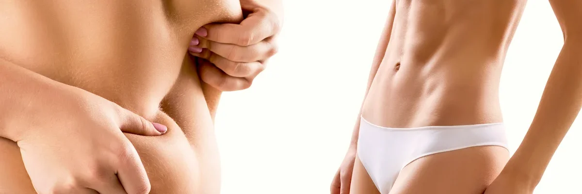 What is Gastric Balloon Surgery