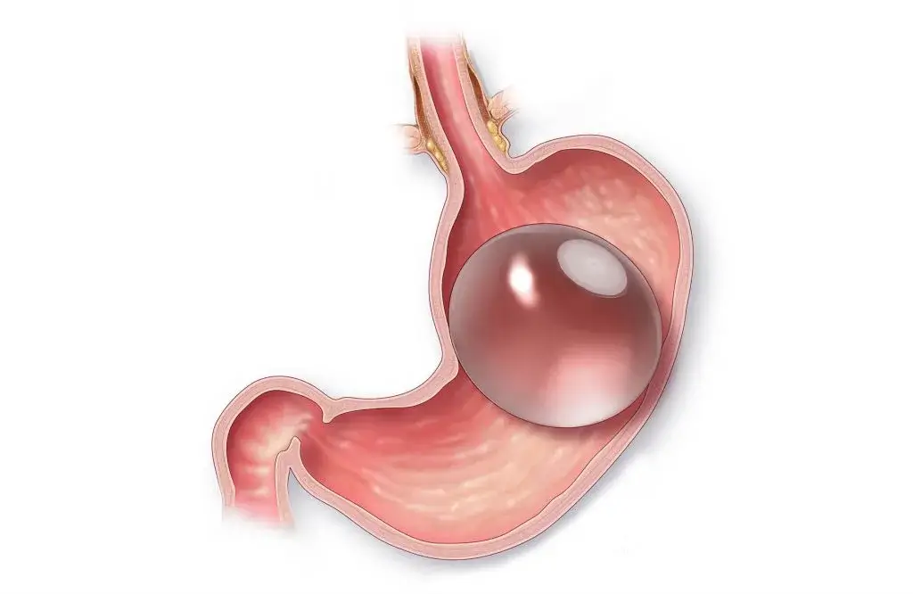 gastric balloon surgery turkey