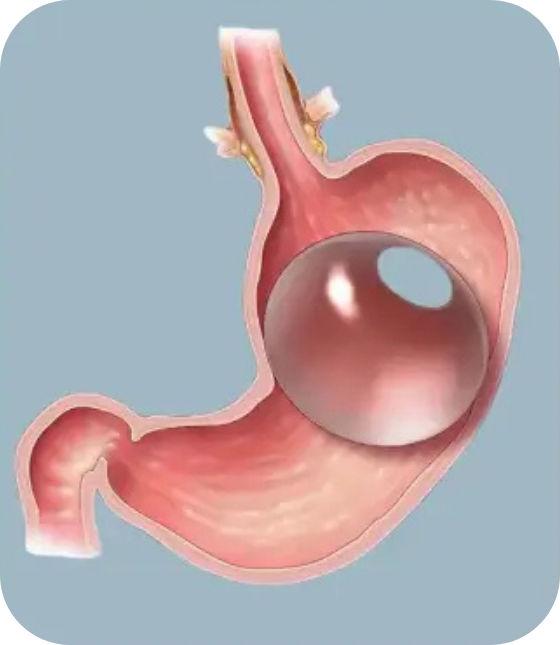 gastric balloon surgery turkey