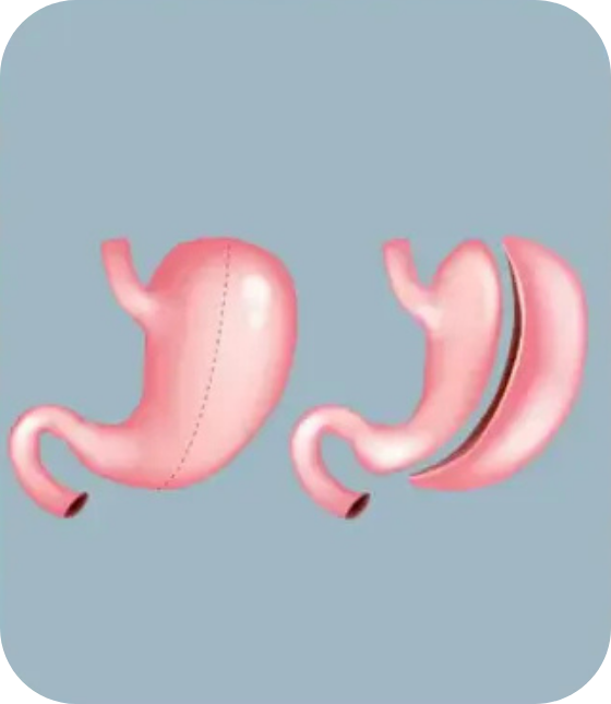 gastric sleeve surgery turkey