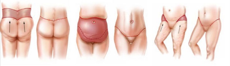 post bariatric body lift surgery turkey