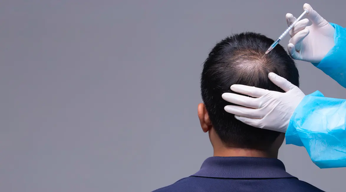 Is a Hair Transplant Permanent?