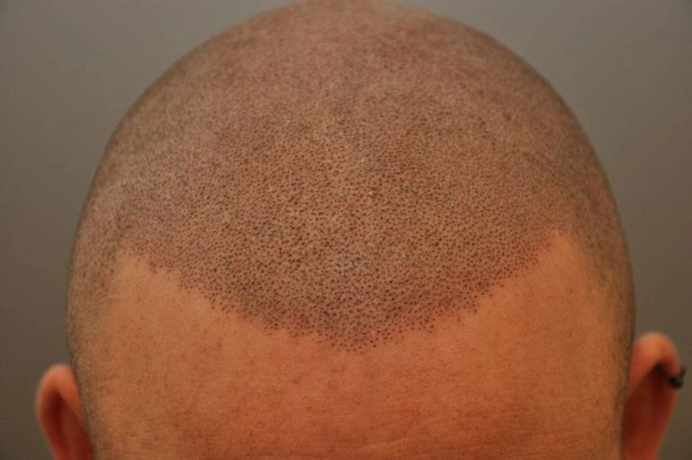 Scalp Micropigmentation After Hair Transplant