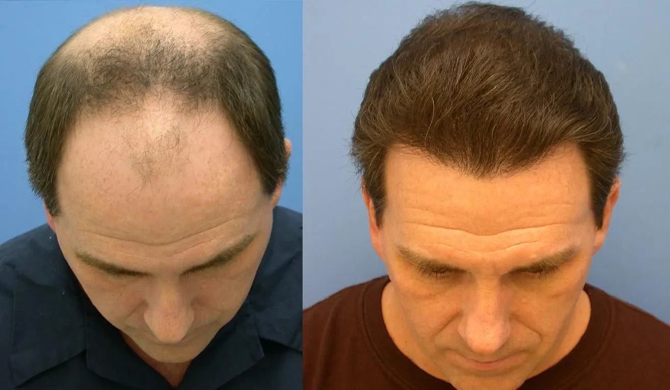 Why Do Hair Transplants Fail?
